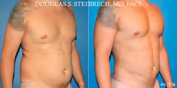 Gynecomastia Before and After Photos in CA, Beverly Hills, Patient 18106