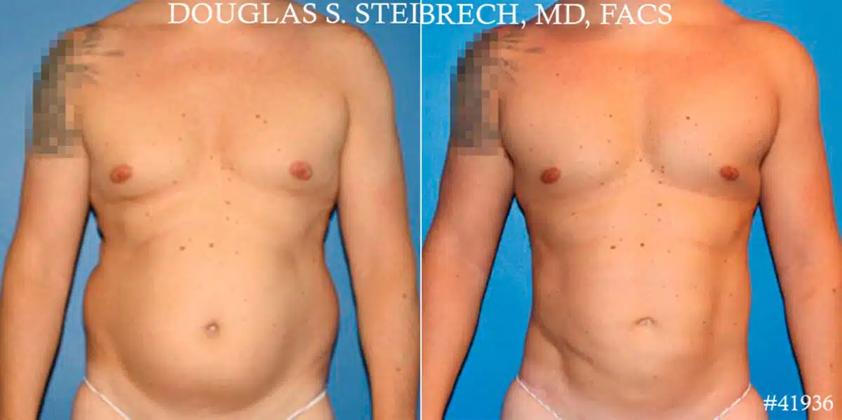 Gynecomastia Before and After Photos in CA, Beverly Hills, Patient 18106