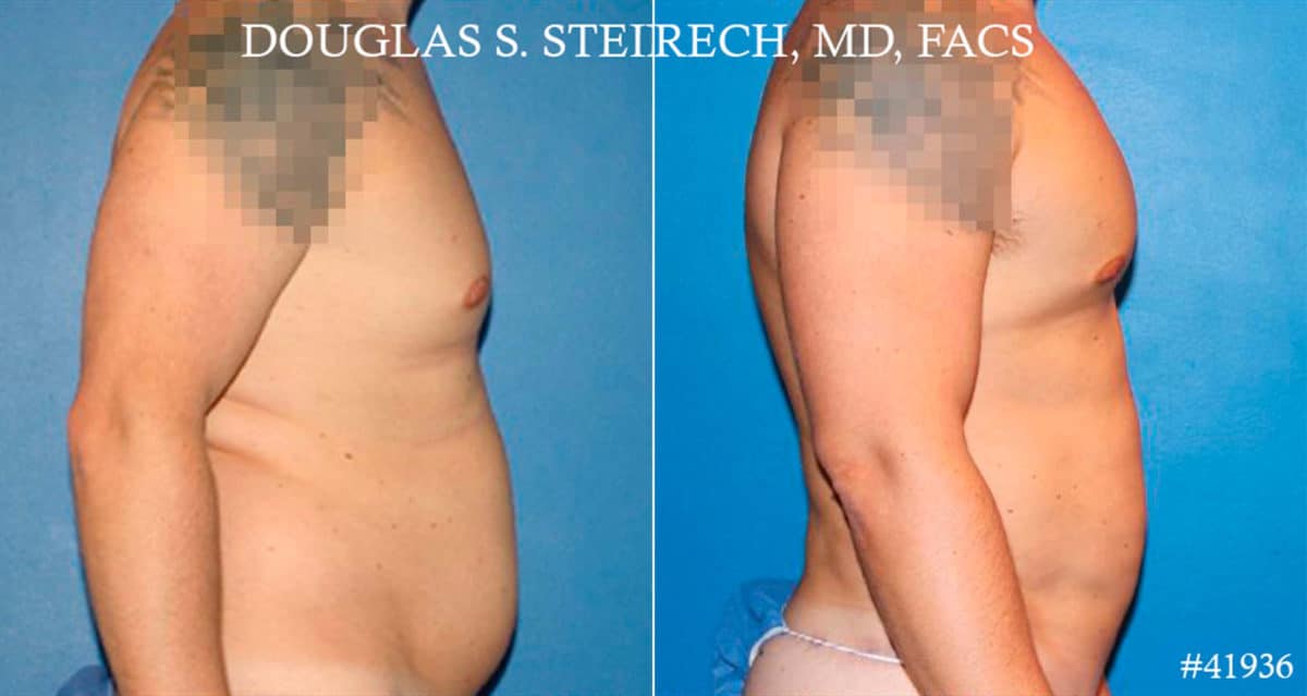 Gynecomastia Before and After Photos in CA, Beverly Hills, Patient 18106