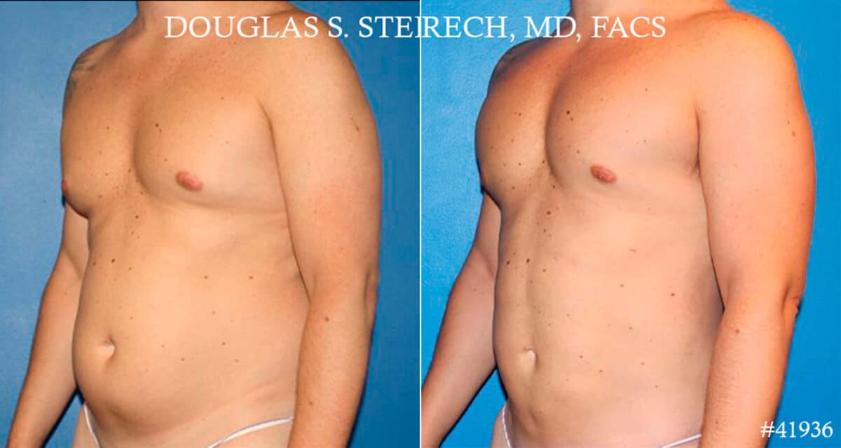 Gynecomastia Before and After Photos in CA, Beverly Hills, Patient 18106