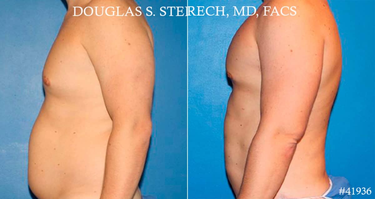 Gynecomastia Before and After Photos in CA, Beverly Hills, Patient 18106