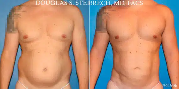 Gynecomastia Before and After Photos in CA, Beverly Hills, Patient 18106