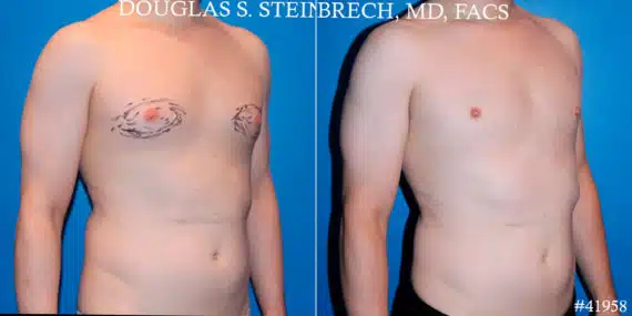 Gynecomastia Before and After Photos in CA, Beverly Hills, Patient 18122