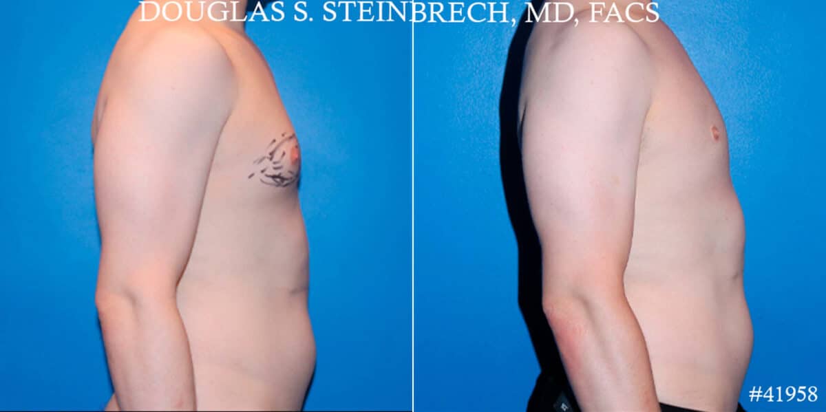 Gynecomastia Before and After Photos in CA, Beverly Hills, Patient 18122