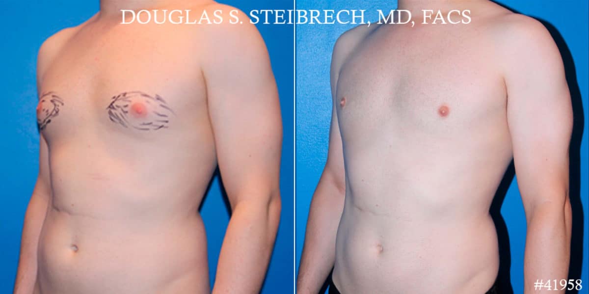 Gynecomastia Before and After Photos in CA, Beverly Hills, Patient 18122