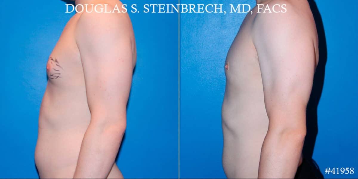 Gynecomastia Before and After Photos in CA, Beverly Hills, Patient 18122