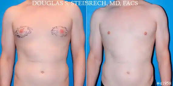 Gynecomastia Before and After Photos in CA, Beverly Hills, Patient 18122