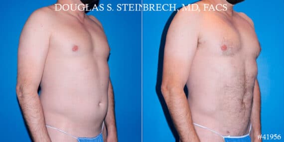 Liposuction Before and After Photos in New York, NY, Patient 18138