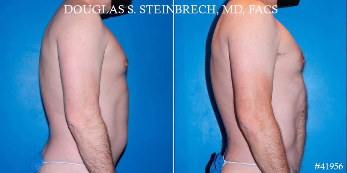 Body Banking Before and After Photos in New York, NY, Patient 18138