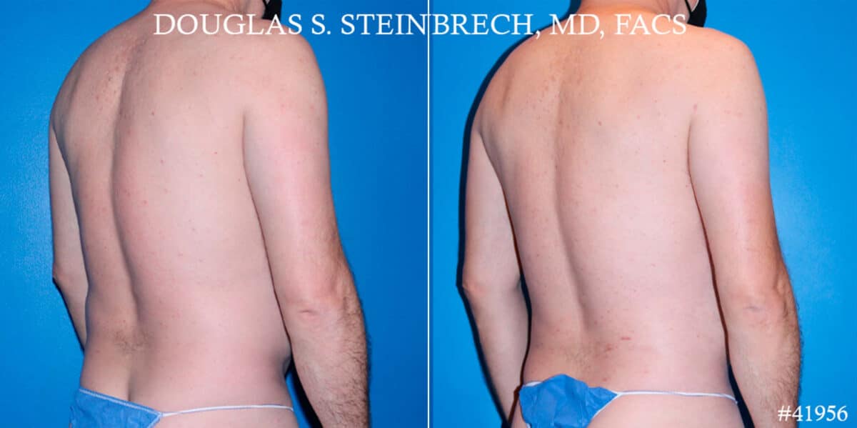 Body Banking Before and After Photos in New York, NY, Patient 18138
