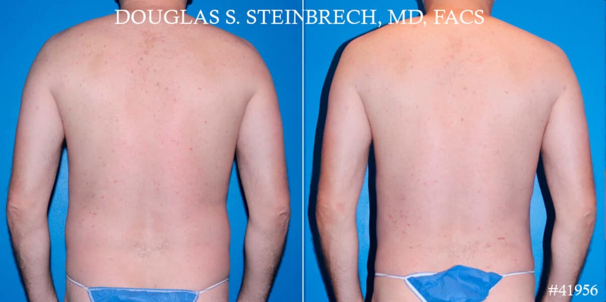 Body Banking Before and After Photos in New York, NY, Patient 18138