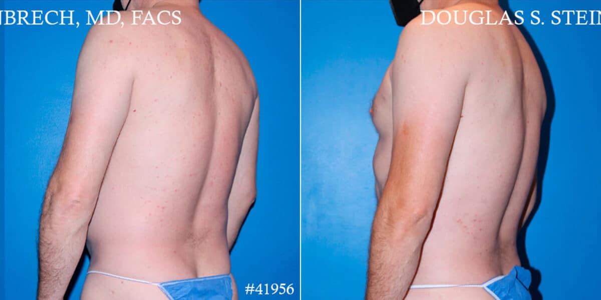 Body Banking Before and After Photos in New York, NY, Patient 18138