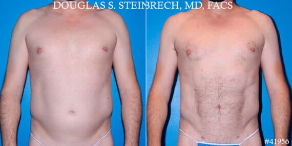 Liposuction Before and After Photos in New York, NY, Patient 18138