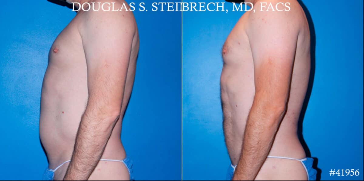 Body Banking Before and After Photos in New York, NY, Patient 18138