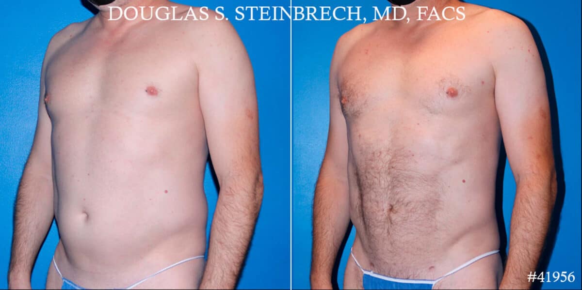 Body Banking Before and After Photos in New York, NY, Patient 18138