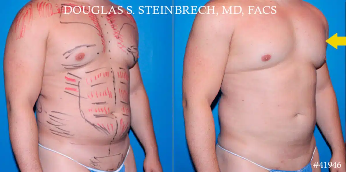 Gynecomastia Before and After Photos in New York, NY, Patient 18139