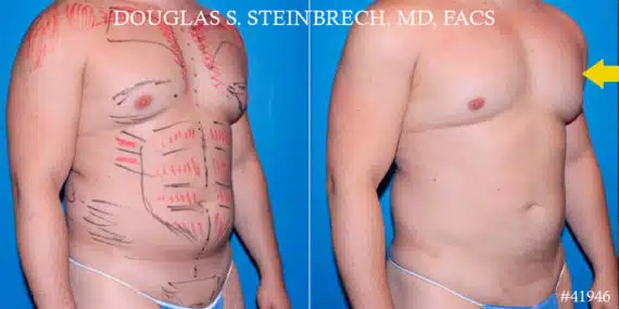 Gynecomastia Before and After Photos in New York, NY, Patient 18139