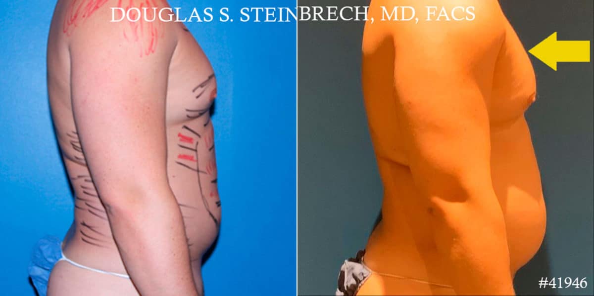 Gynecomastia Before and After Photos in New York, NY, Patient 18139