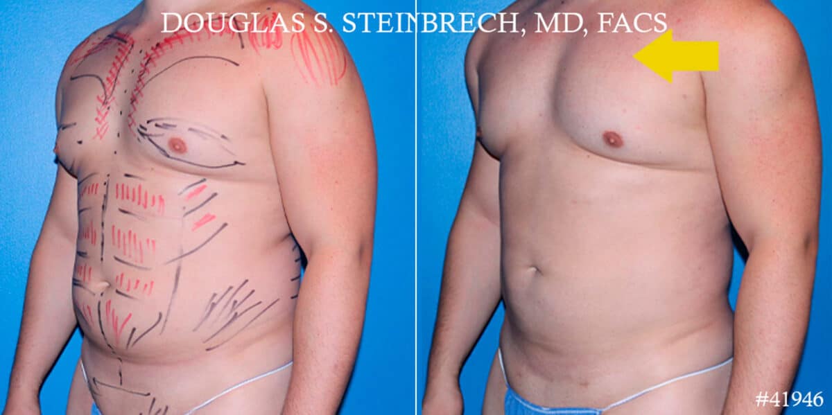 Gynecomastia Before and After Photos in New York, NY, Patient 18139