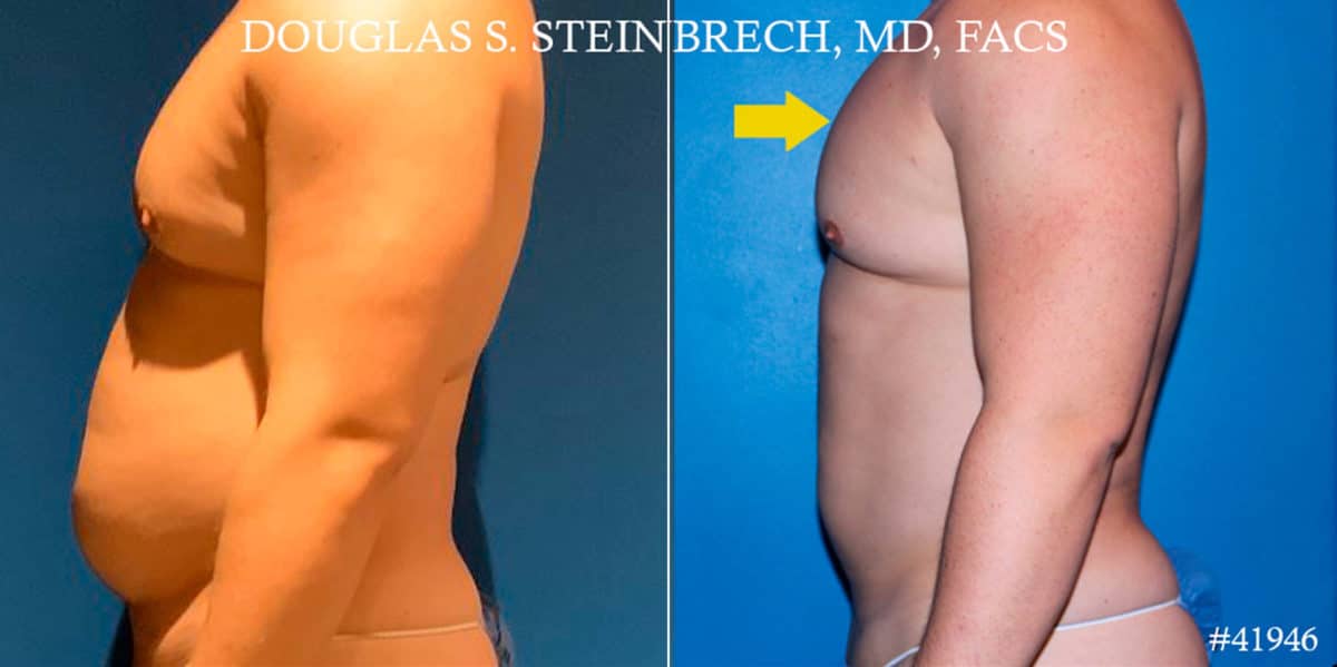 Gynecomastia Before and After Photos in New York, NY, Patient 18139