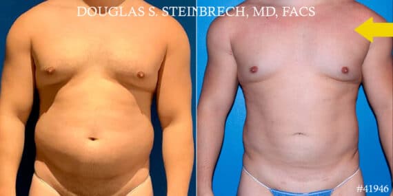 Gynecomastia Before and After Photos in New York, NY, Patient 18139