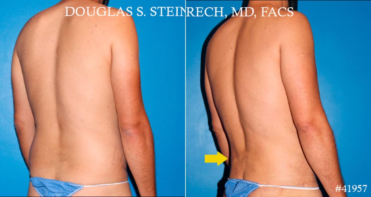 Body Banking Before and After Photos in New York, NY, Patient 18181