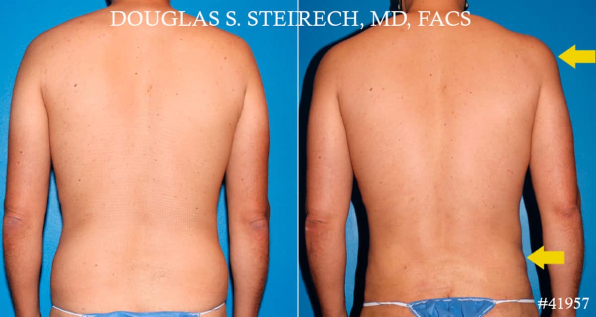 Body Banking Before and After Photos in New York, NY, Patient 18181