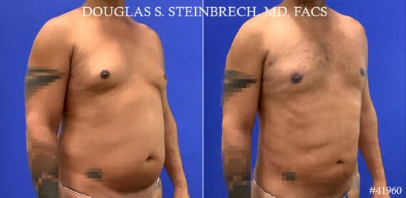 Gynecomastia Before and After Photos in New York, NY, Patient 18368