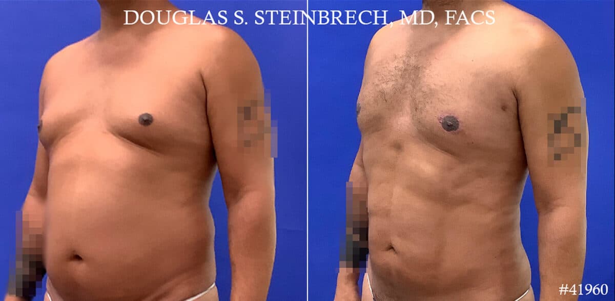 Gynecomastia Before and After Photos in New York, NY, Patient 18368