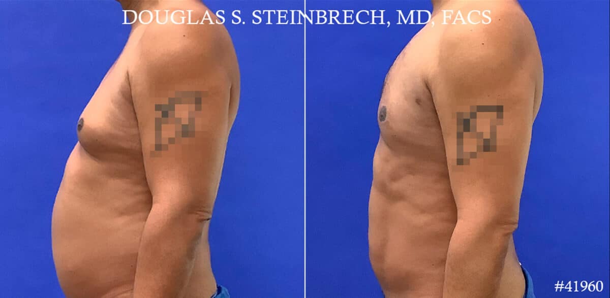 Gynecomastia Before and After Photos in New York, NY, Patient 18368