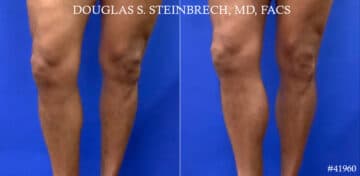 Calf Implants Before and After Photos in New York, NY, Patient 18384