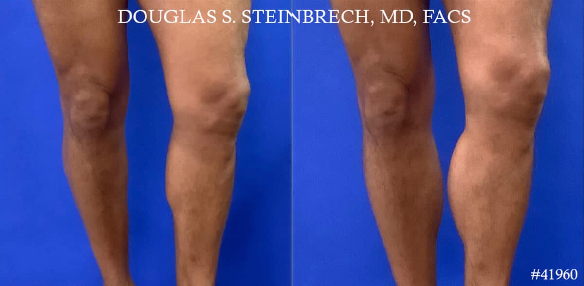 Calf Implants Before and After Photos in New York, NY, Patient 18384