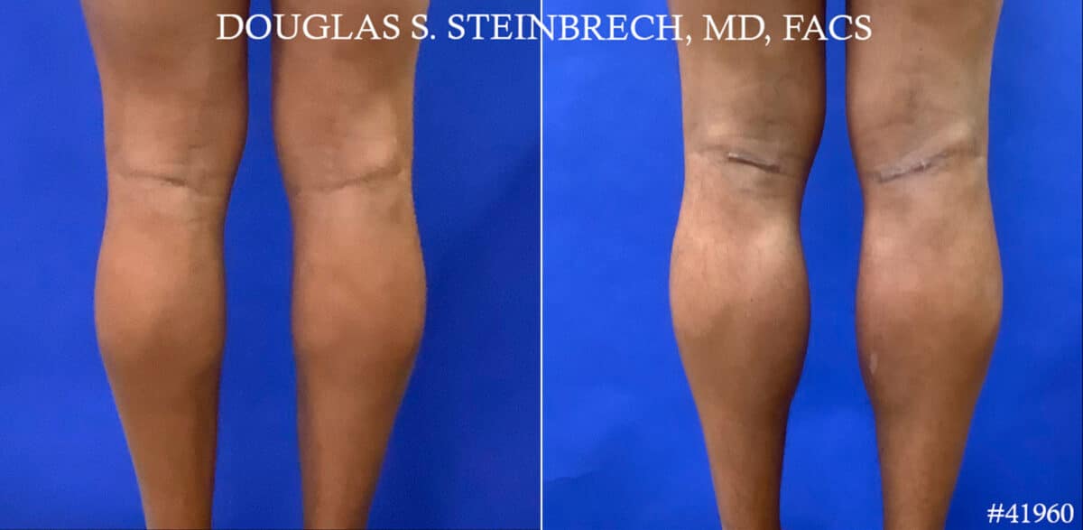 Calf Implants Before and After Photos in New York, NY, Patient 18384