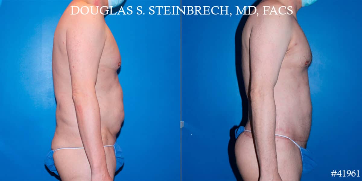 Body Banking Before and After Photos in New York, NY, Patient 18508