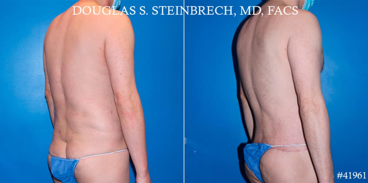 Body Banking Before and After Photos in New York, NY, Patient 18508