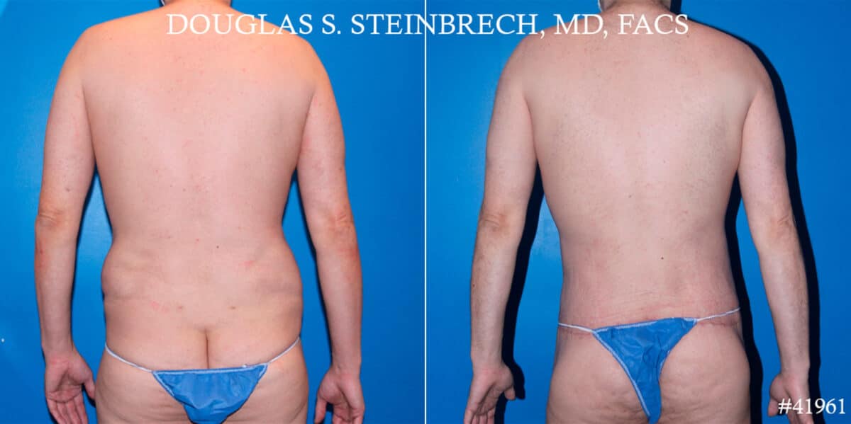 Body Banking Before and After Photos in New York, NY, Patient 18508