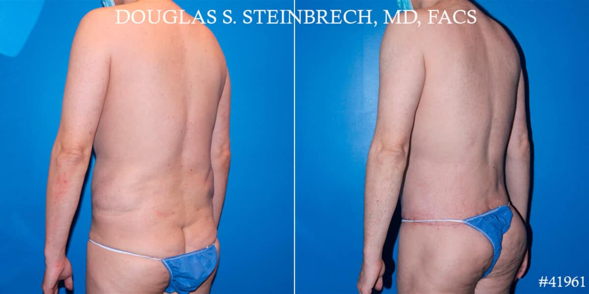 Body Banking Before and After Photos in New York, NY, Patient 18508
