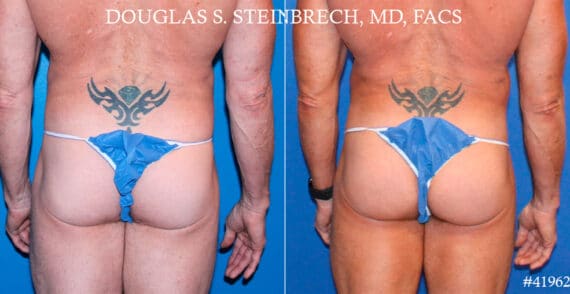 Gluteal Augmentation Before and After Photos in New York, NY, Patient 18520