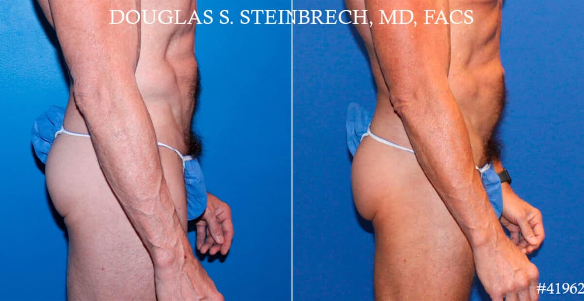 Gluteal Augmentation Before and After Photos in New York, NY, Patient 18520