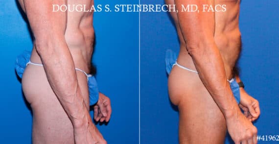 Gluteal Augmentation Before and After Photos in New York, NY, Patient 18520