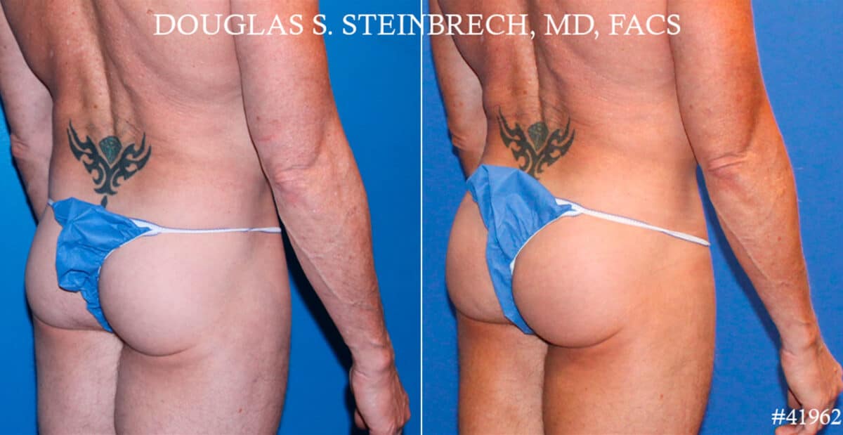 Gluteal Augmentation Before and After Photos in New York, NY, Patient 18520