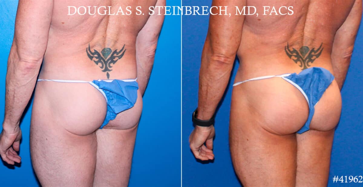 Gluteal Augmentation Before and After Photos in New York, NY, Patient 18520