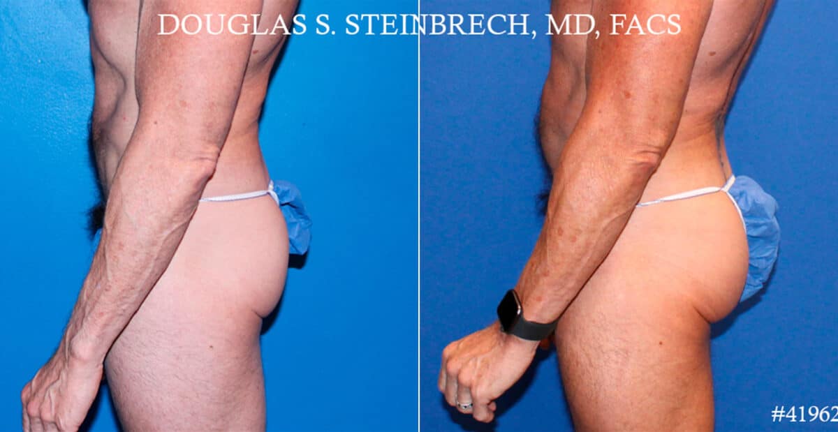 Gluteal Augmentation Before and After Photos in New York, NY, Patient 18520