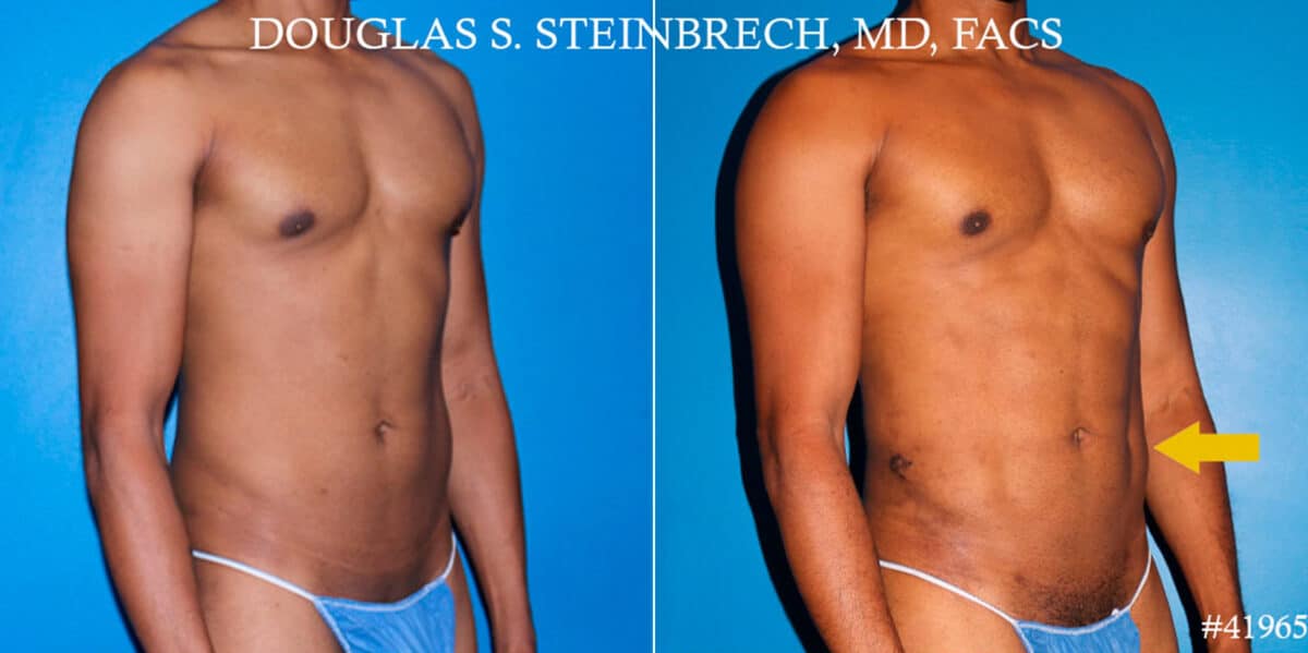 Liposuction Before and After Photos in CA, Beverly Hills, Patient 18585