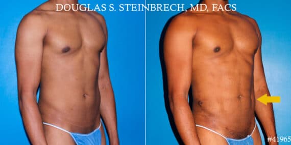 Liposuction Before and After Photos in CA, Beverly Hills, Patient 18585