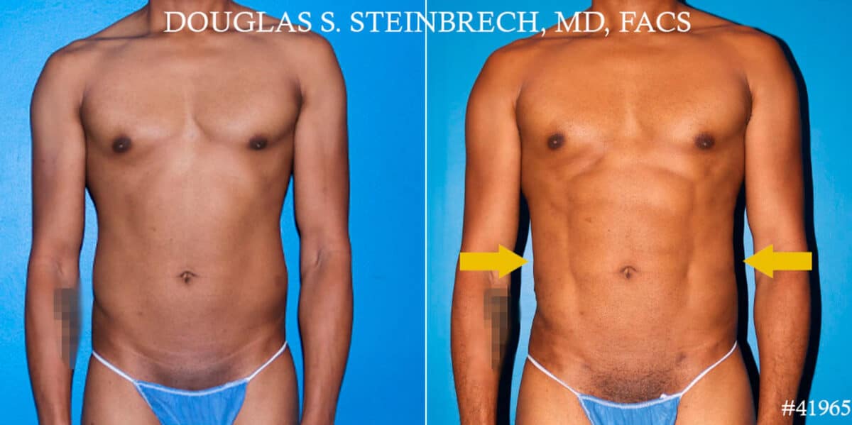 Liposuction Before and After Photos in CA, Beverly Hills, Patient 18585