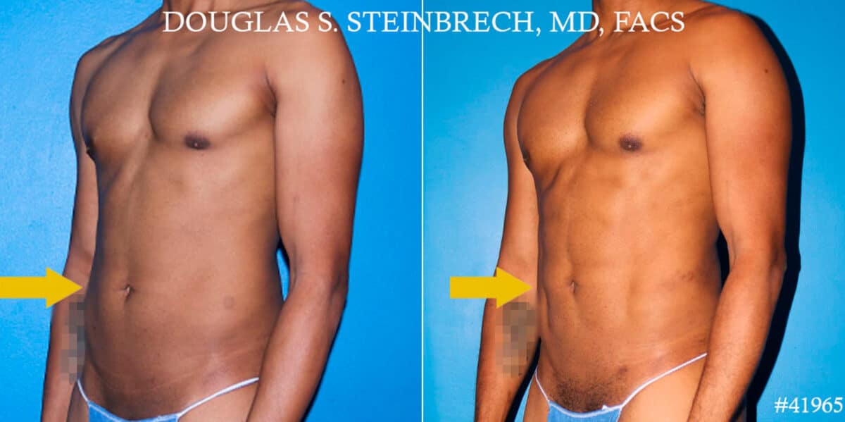 Liposuction Before and After Photos in CA, Beverly Hills, Patient 18585