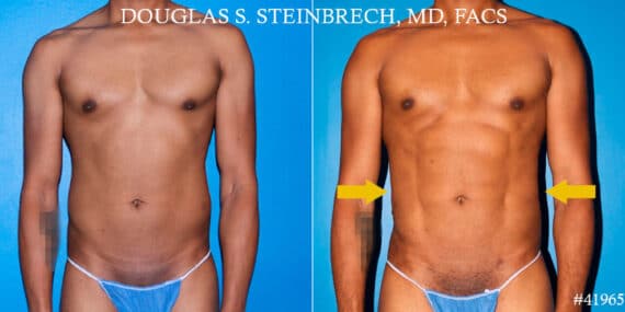 Liposuction Before and After Photos in CA, Beverly Hills, Patient 18585