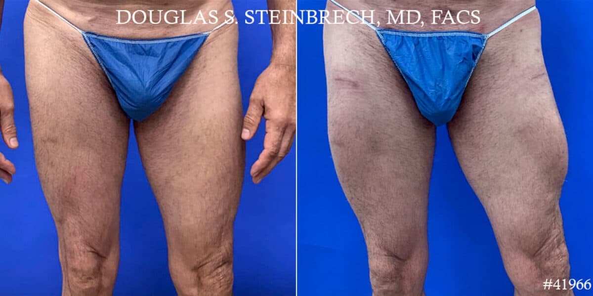 Calf Implants Before and After Photos in CA, Beverly Hills, Patient 18598