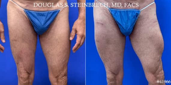 Calf Implants Before and After Photos in CA, Beverly Hills, Patient 18598